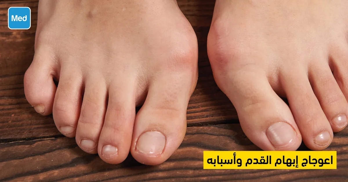 اعوجاج إبهام القدم وأسبابه 